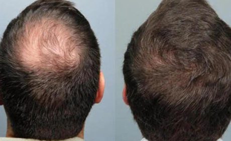بهترین و حداقل سن برای کاشت ابرو و کاشت مو