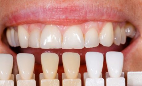 ویژگی های بهترین متخصص لمینت دندان در تهران