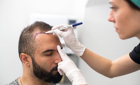 آیا کاشت مو، ابرو و کاشت ریش درد دارد؟