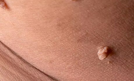زگیل تناسلی چیست و چگونه درمان می‌شود؟