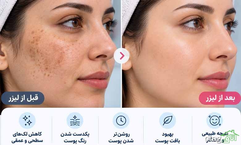 چند جلسه لیزر برای لک صورت لازم است؟ تعداد جلسات و زمان دیدن نتیجه