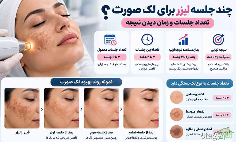 چند جلسه لیزر برای لک صورت لازم است؟ تعداد جلسات و زمان دیدن نتیجه